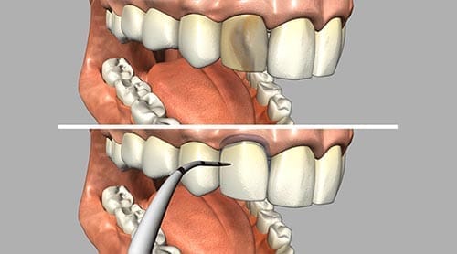 Picture of what a veneer can do- such as cover up a bad looking tooth.